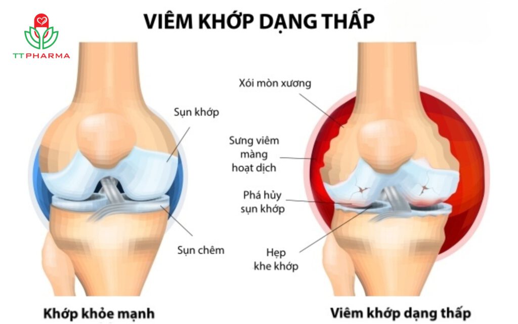 viêm khớp dạng thấp