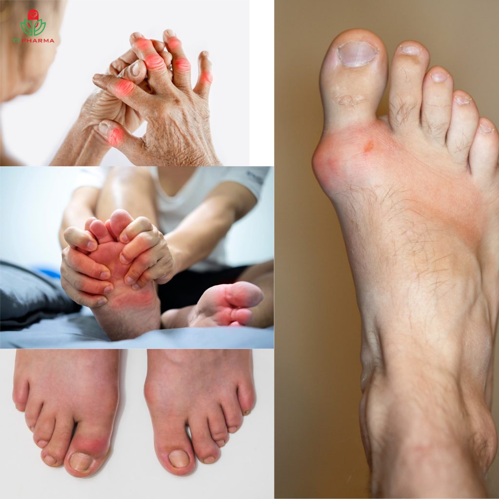 benh-gout